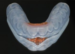 Recreational mouth guard